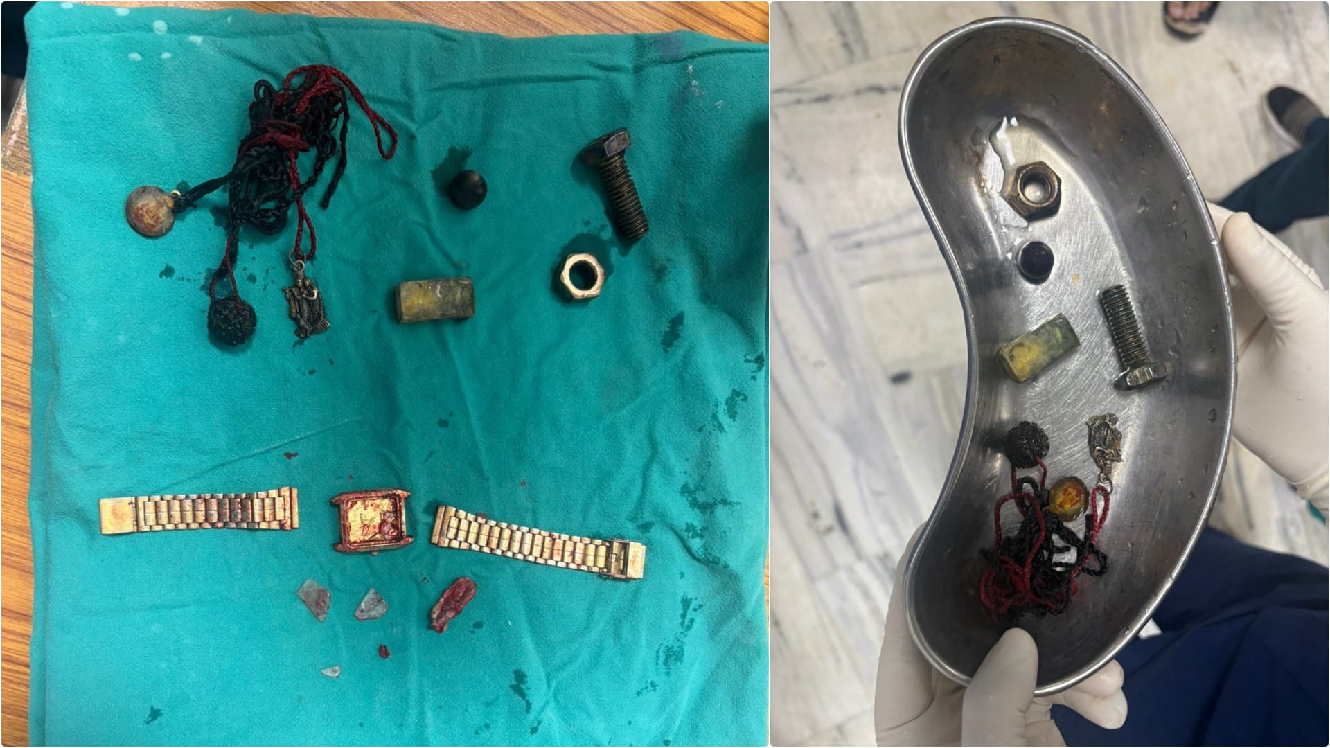 SMS Hospital removes watch from patient's esophagus using telescope nuts-bolts removed from large intestine