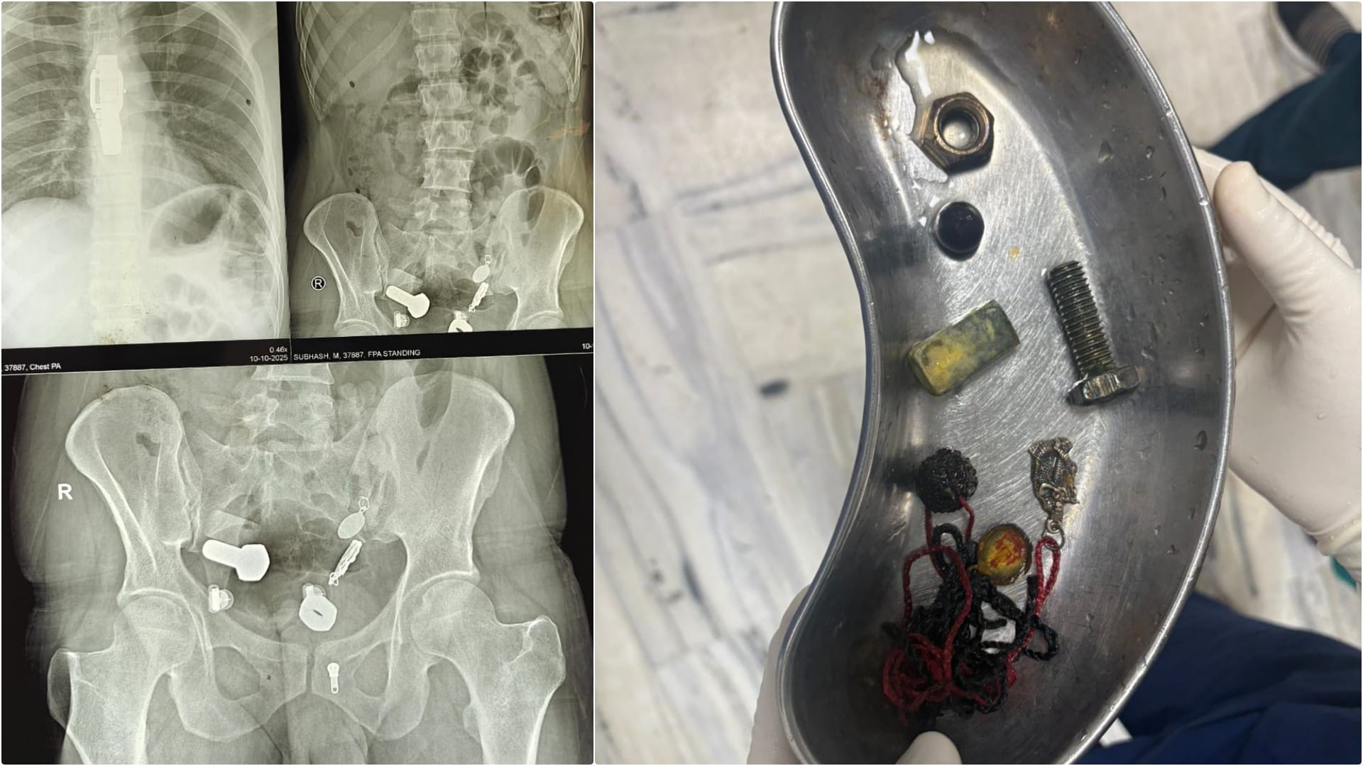 SMS Hospital removes watch from patient's esophagus using telescope nuts-bolts removed from large intestine