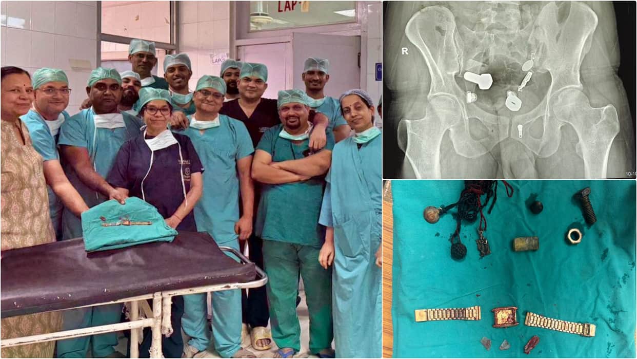 SMS Hospital removes watch from patient's esophagus using telescope nuts-bolts removed from large intestine