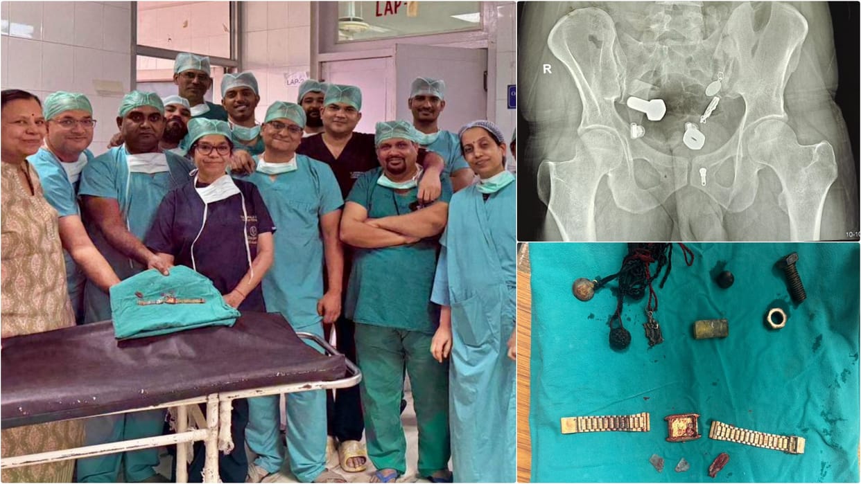 SMS Hospital removes watch from patient's esophagus using telescope nuts-bolts removed from large intestine