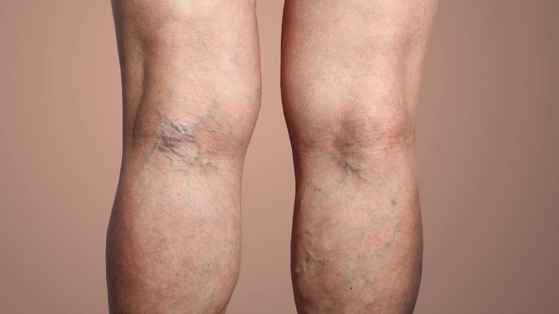 5 Easy Home Remedies for Leg Pain Relief varicose veins Doctor Pairon ke dard ke gharelu upay