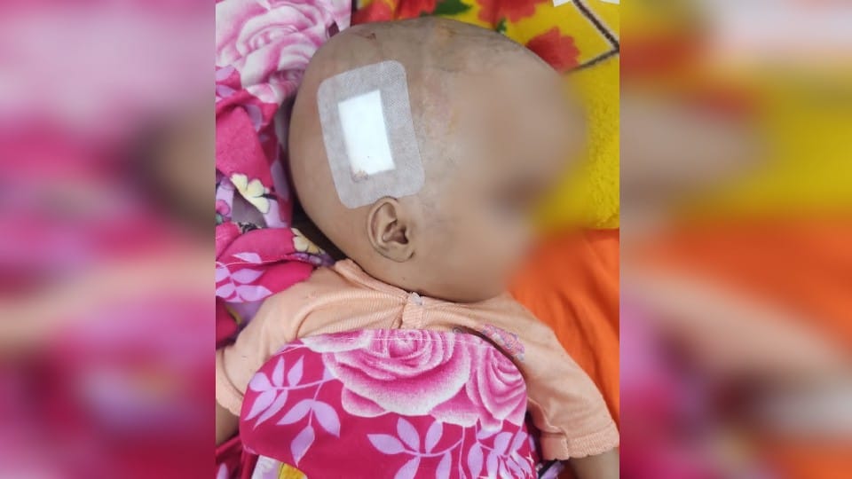 Head surgery on six-month-old baby with hydrocephalus at sn medical college in agra