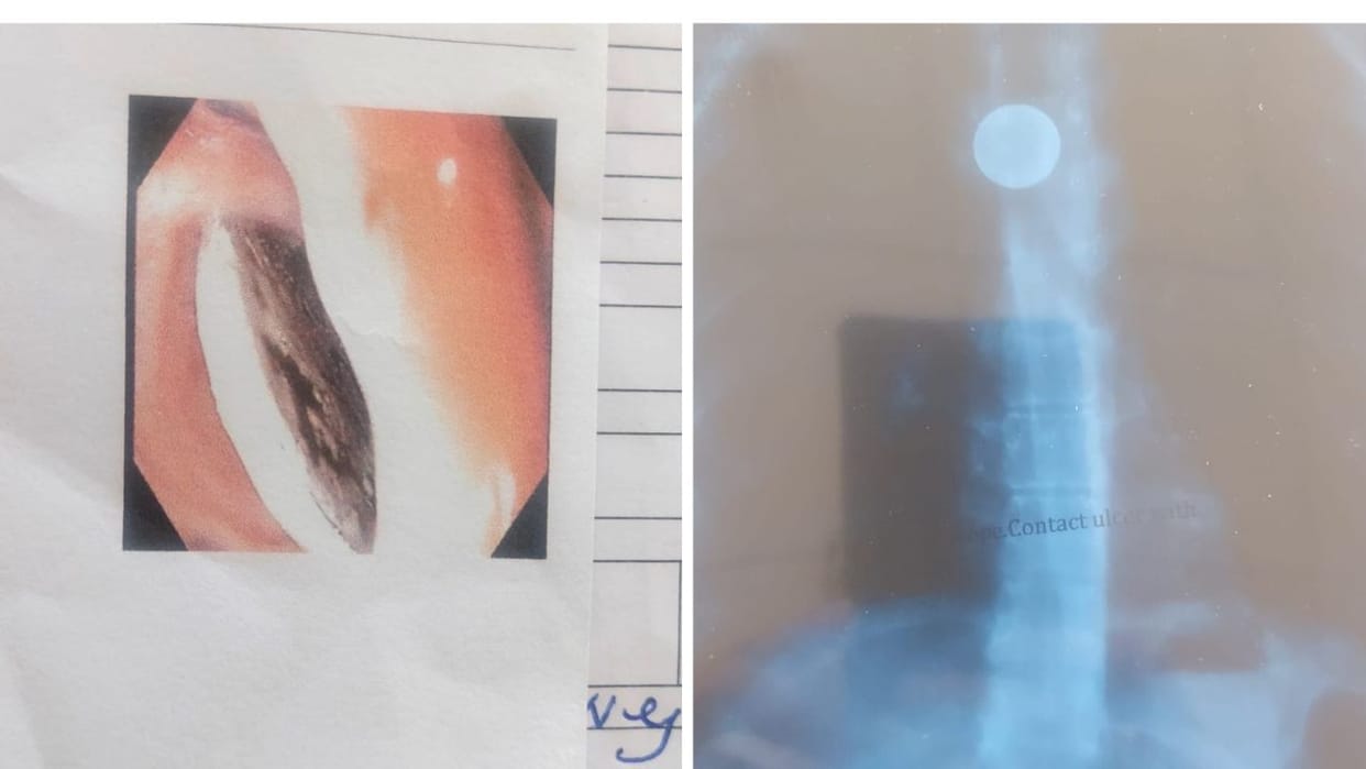 Himachal Shimla A coin was stuck in the food pipe for 15 years doctors removed it in 20 minutes