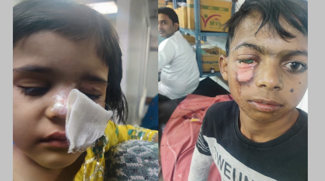 Kanpur 28 people suffered burns from firecrackers treatment underway at Hallet one persons eye ruptured
