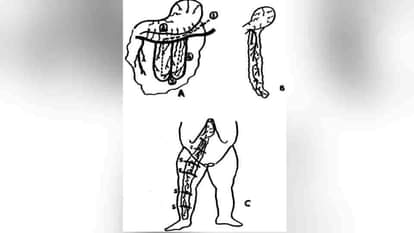 Uttarakhand News: For the first time in India intestinal membrane was implanted in feet through a tunnel
