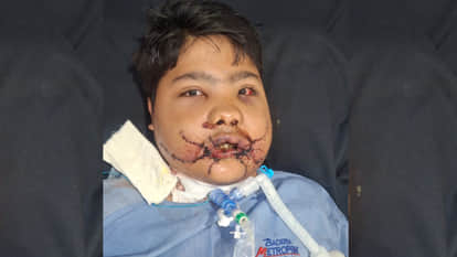 Bomb blast fractured 108 bones in minor's face, doctors restored his life with a two-and-a-half-hour operation