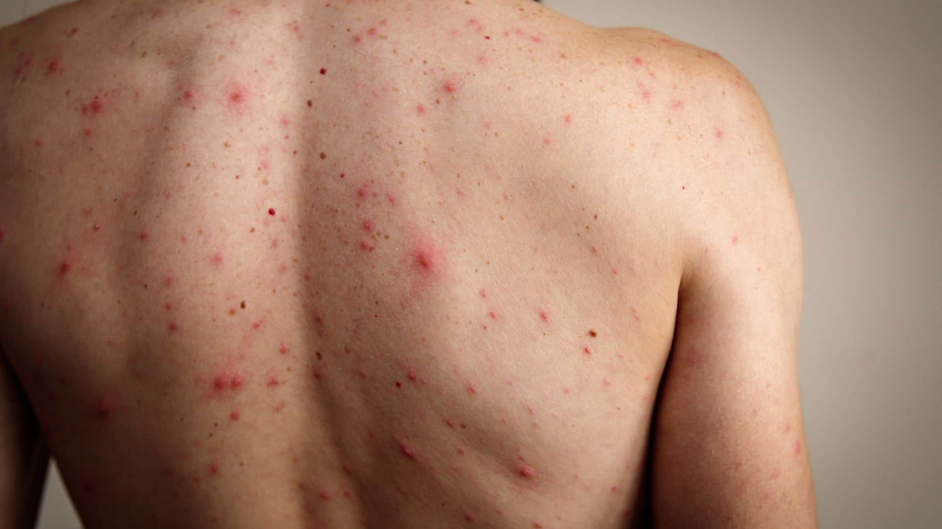 Monkeypox vs Chickenpox Difference and Symptoms All Explained in Hindi