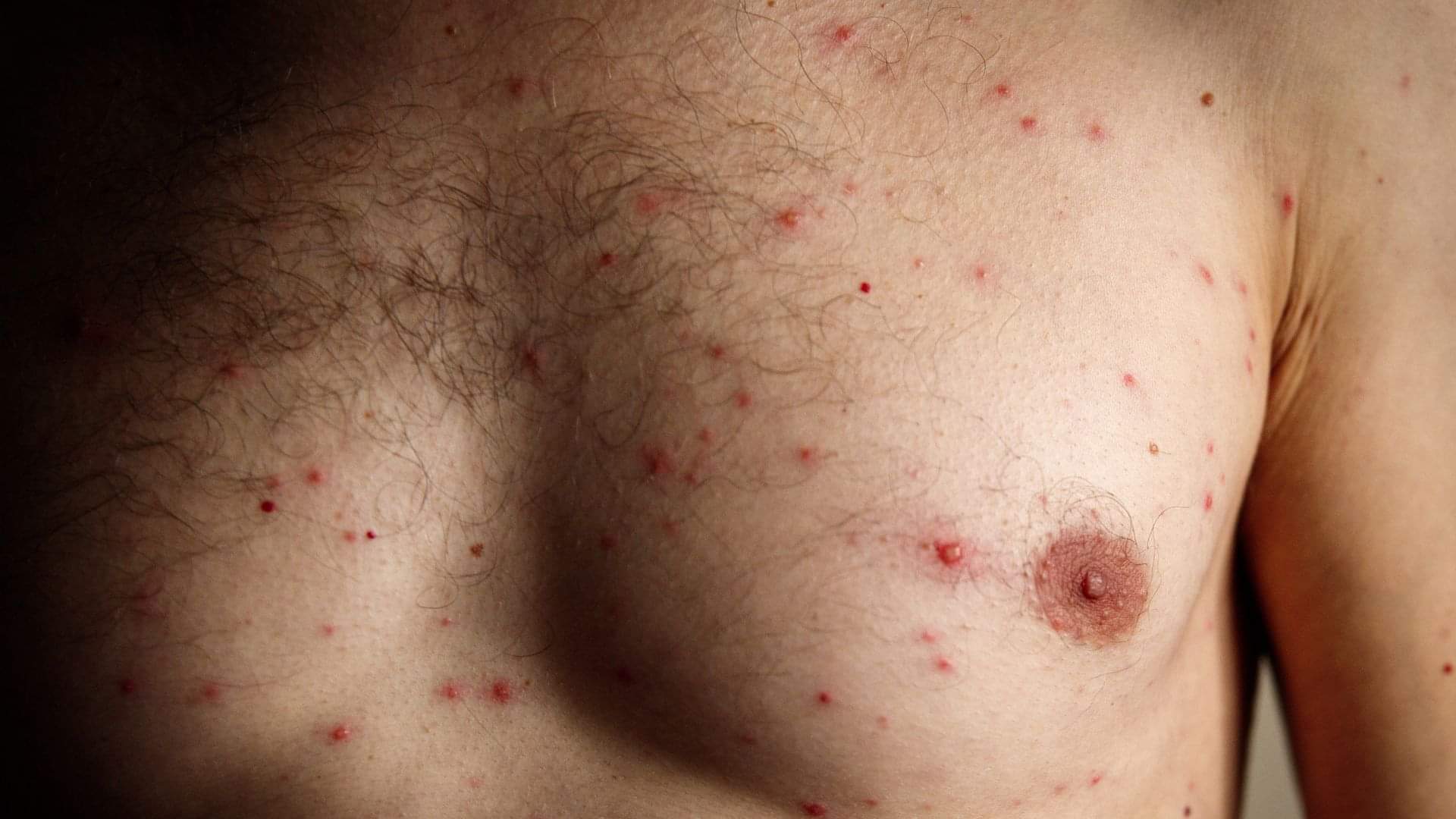 Fever Lasting More Than 5 Days Warning Signs and Possible Health Risks explained in Hindi