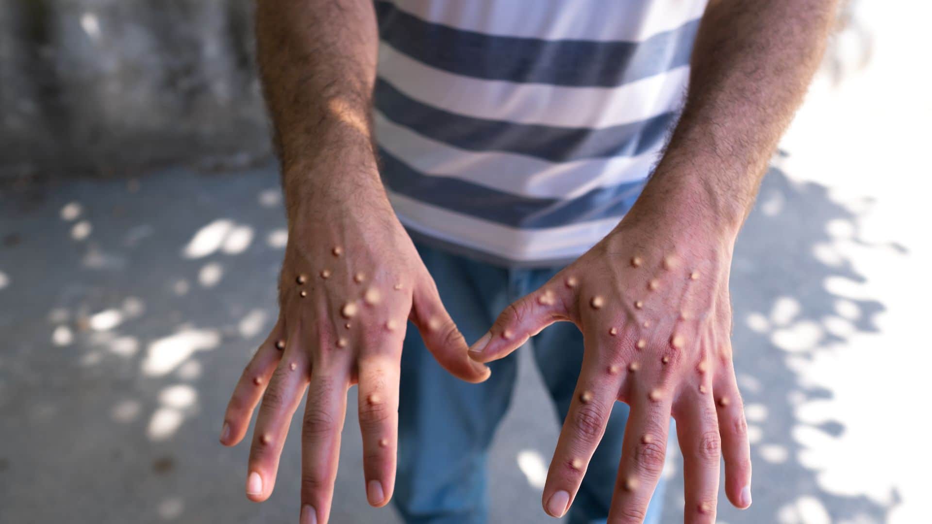 Monkeypox vs Chickenpox Difference and Symptoms All Explained in Hindi