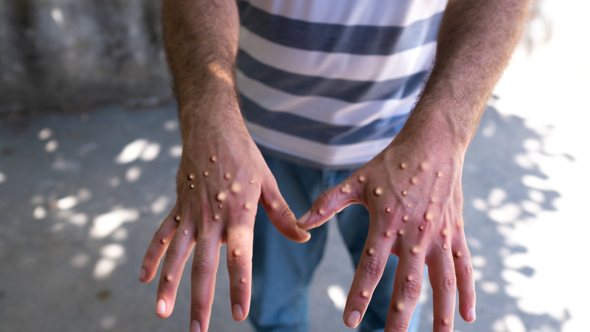 Monkeypox vs Chickenpox Difference and Symptoms All Explained in Hindi