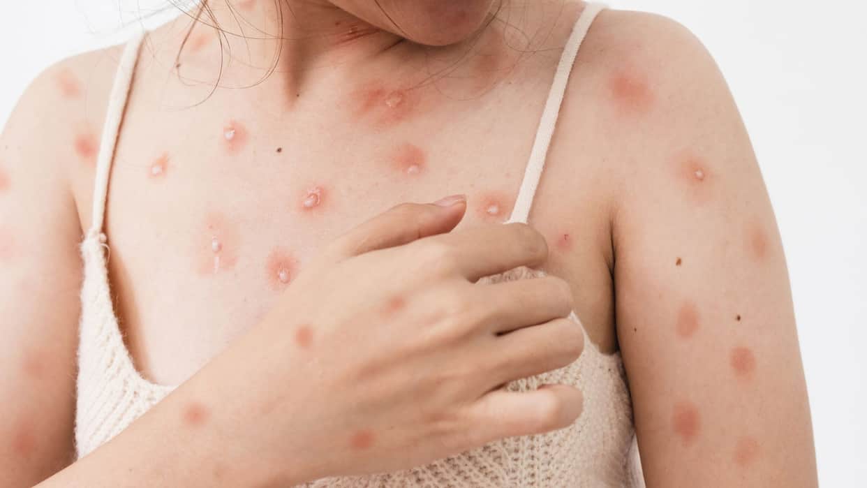 Monkeypox vs Chickenpox Difference and Symptoms All Explained in Hindi