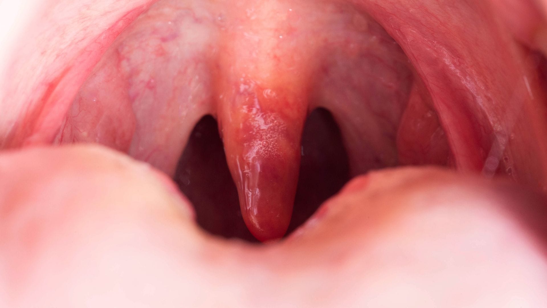Home Remedies for Tonsillitis Swollen Throat Pain in Winter These Desi Cures Can Provide Immediate Relief