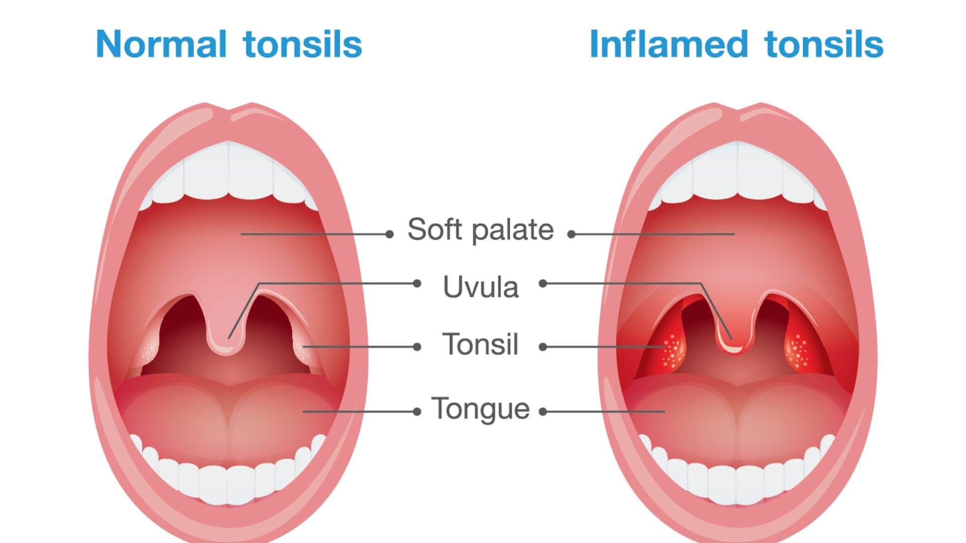 Home Remedies for Tonsillitis Swollen Throat Pain in Winter These Desi Cures Can Provide Immediate Relief