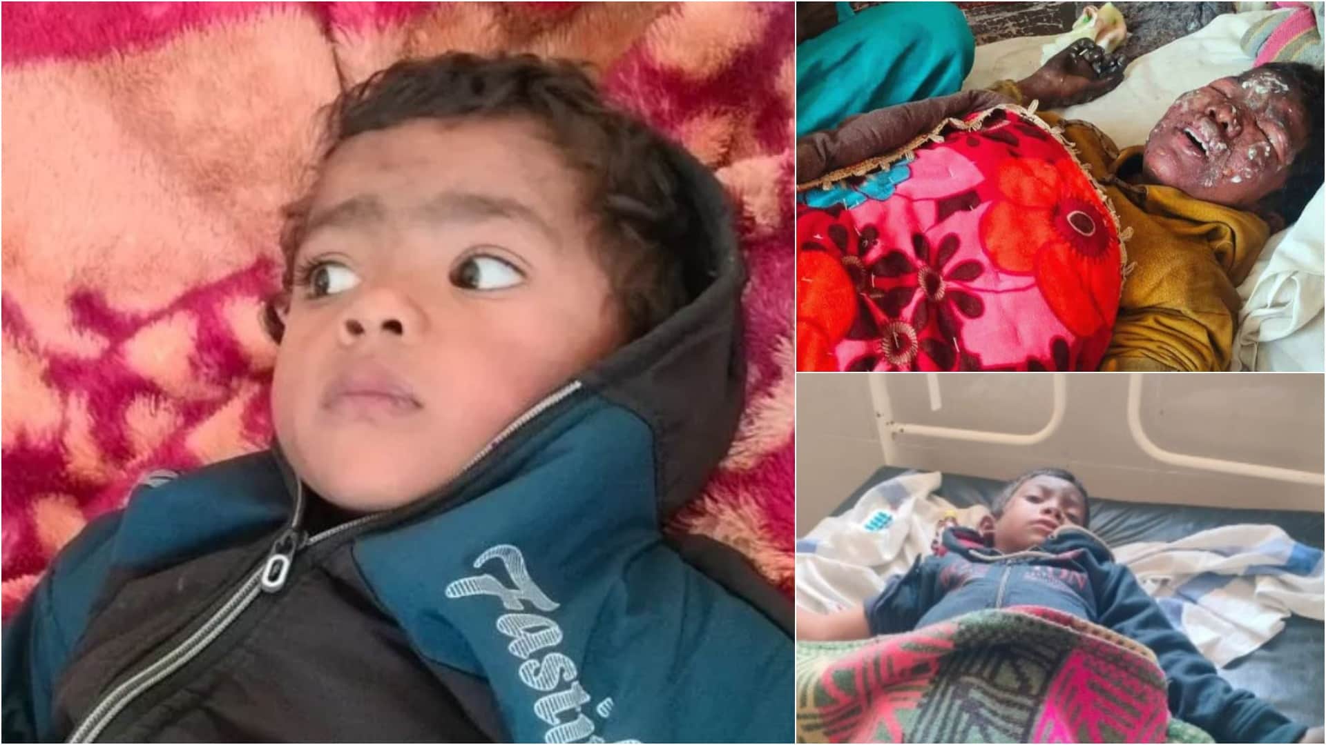 आग में झुलसे तीन मासूम