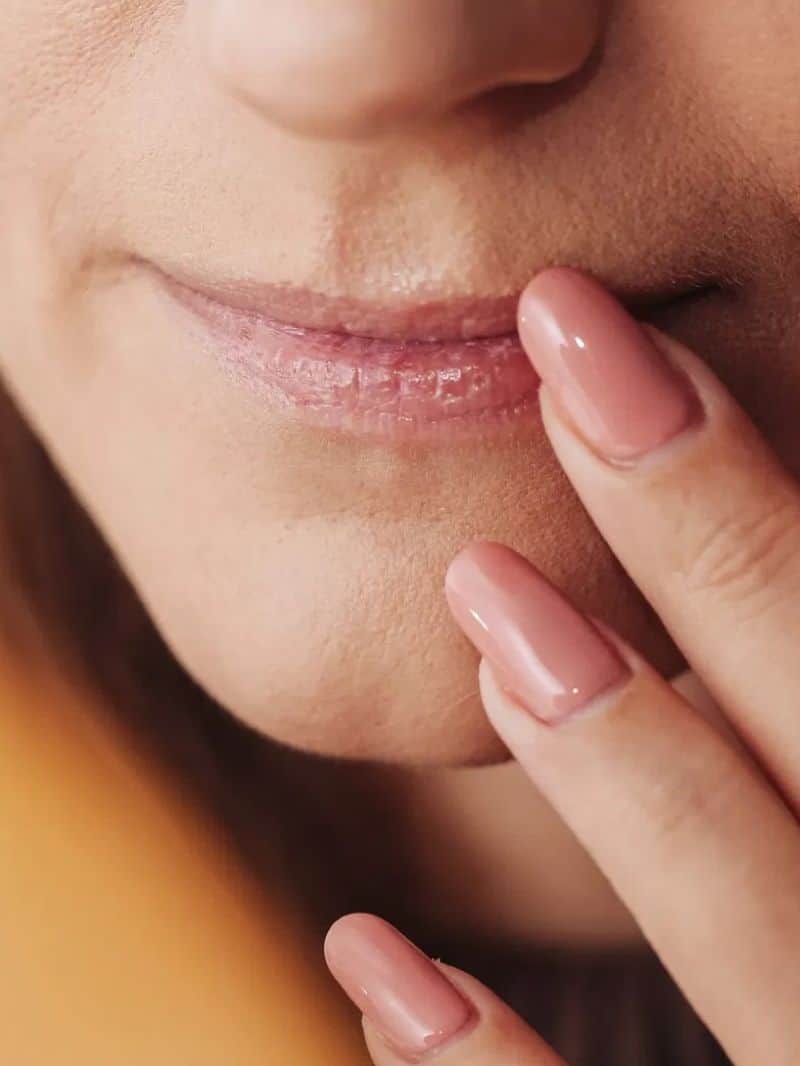 होठ फटने की परेशानी