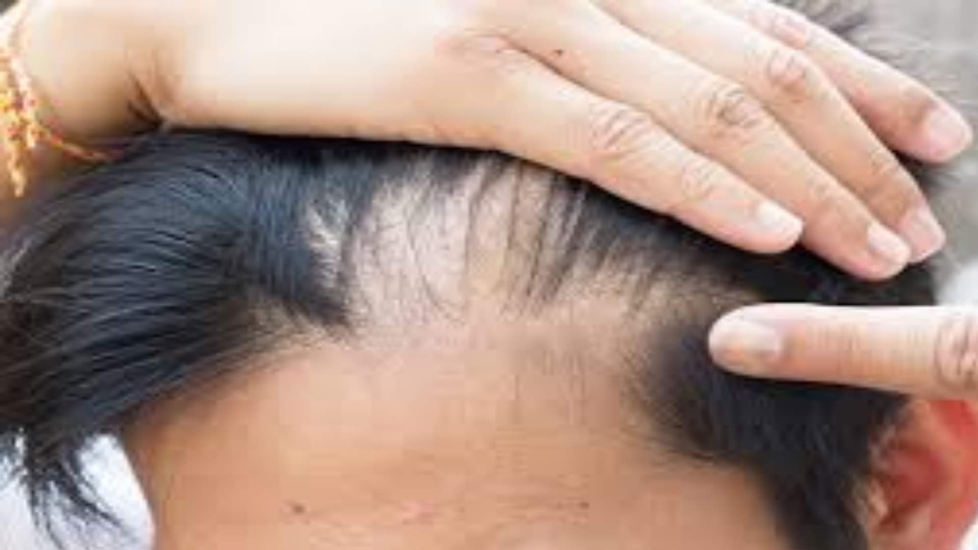 बाल झड़ना।