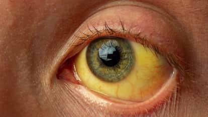 Jaundice wreaks havoc in Mainpat four deaths in a month dozens affected in several villages in Ambikapur