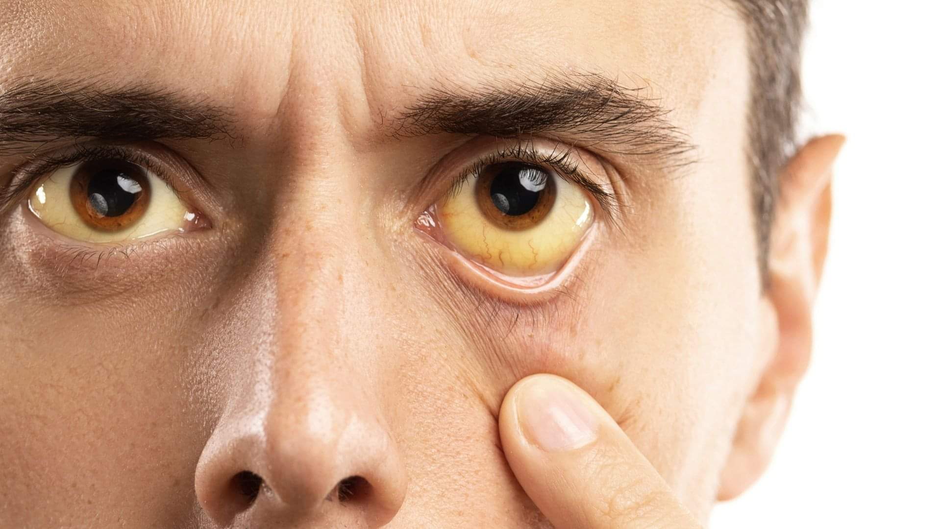 Yellow Eyes Warning Early Symptoms of Jaundice You Should Never Ignore