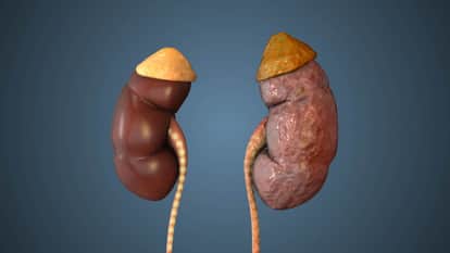 किडनी में पथरी की शिकायत