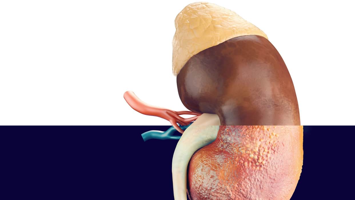 Should kidney stone patients eat fried food Know which things should be completely avoided