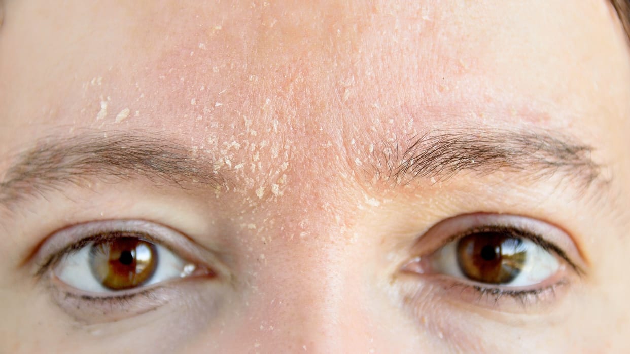 How to remove dandruff from eyebrow