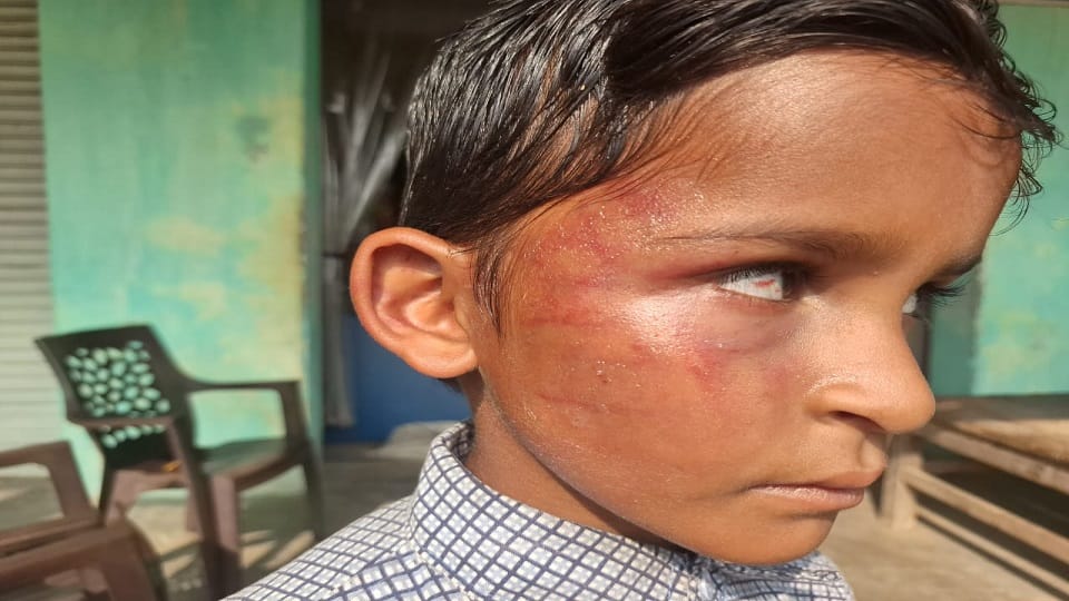 Teacher beats child for not being able to recite the count blood comes out of the child eyes instructions for