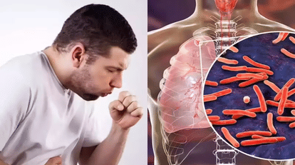 indore news tb cases surge as city reports 76,549 patients and 1,833 deaths since 2018