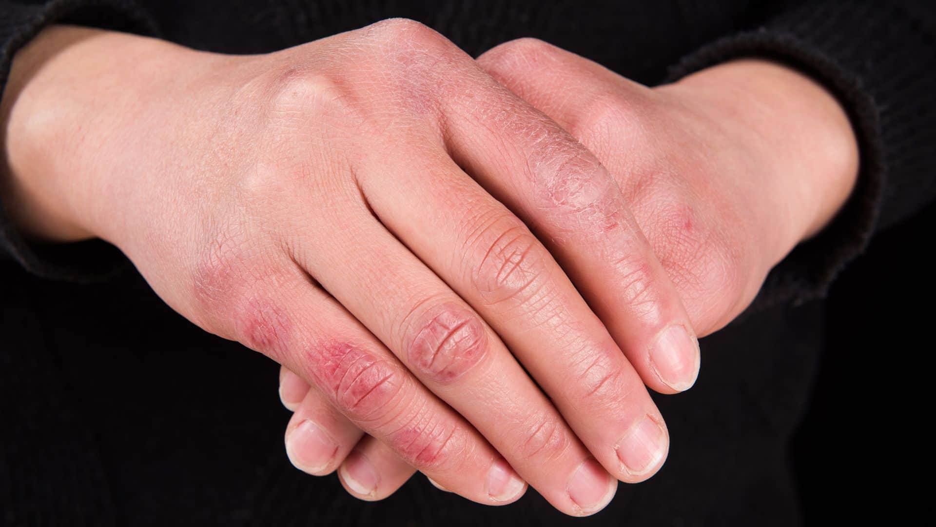 Why do fingers and toes swell in the Winter Swollen Fingertip know preventive measures