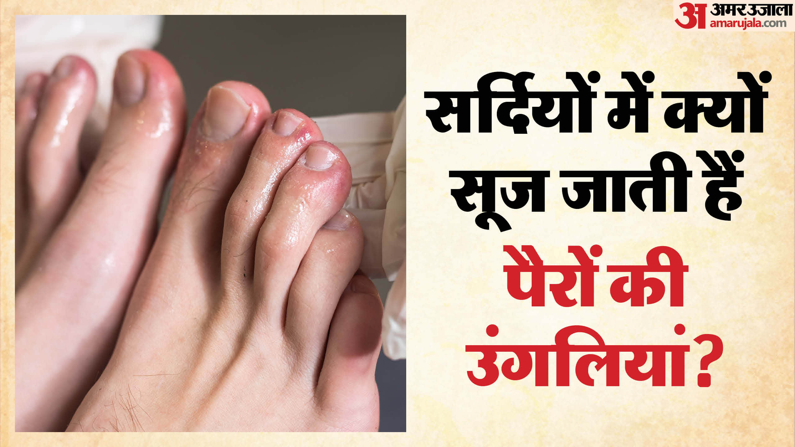 Why do fingers and toes swell in the Winter Swollen Fingertip know preventive measures