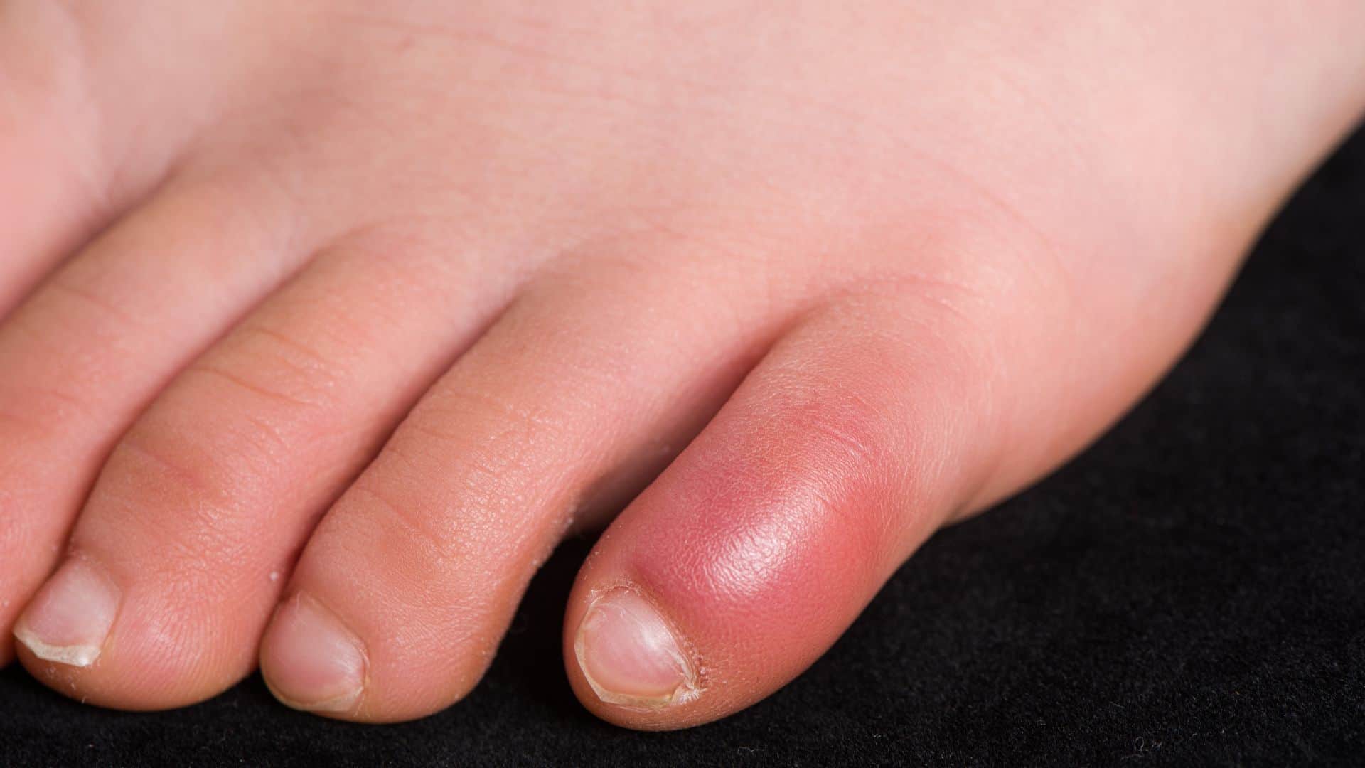 Why do fingers and toes swell in the Winter Swollen Fingertip know preventive measures