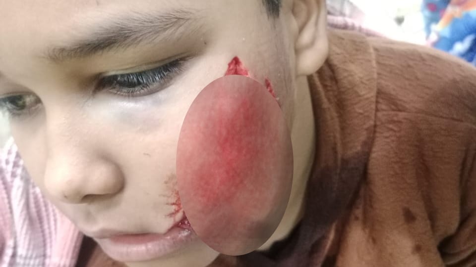 stray dog attacked nine-year-old boy in Ludhiana