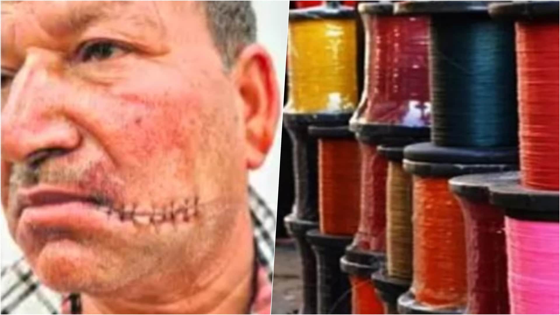 चायनीज मांझे से घायल हुआ नगर सैनिक का चेहरा