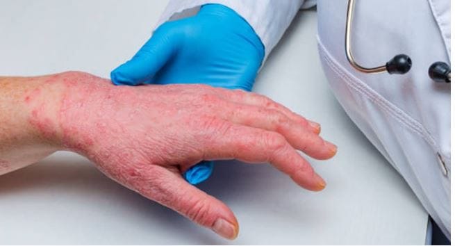 Cold Weather Triggers Sore Throat Swelling and Psoriasis Cases in Agra