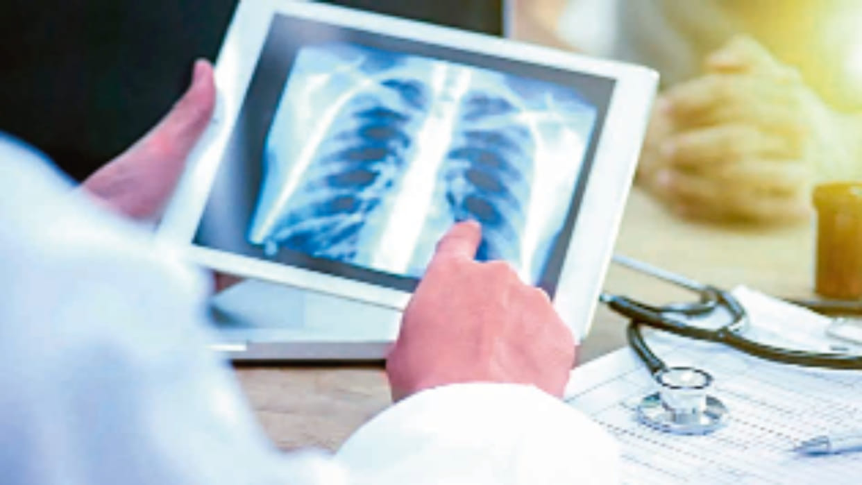 Tuberculosis cases are declining rapidly across the country