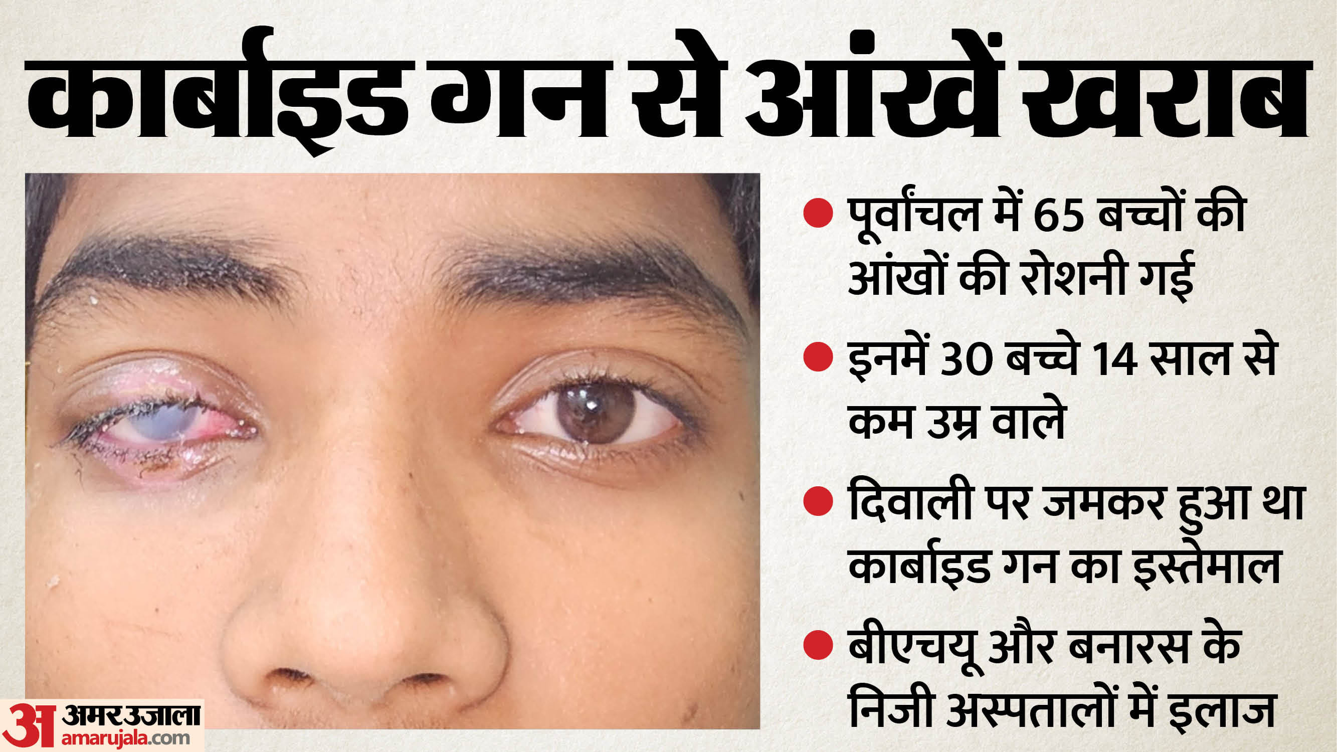 Up:कार्बाइड गन से पूर्वांचल में 65 बच्चों की आंखों की रोशनी गई, दीपावली ...