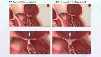 What Is TEER? Treating Heart Disease Without Surgery Know all about it