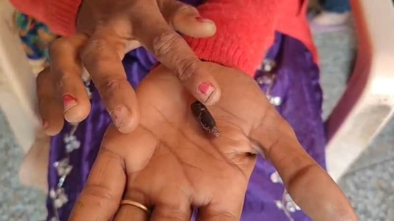 A bullet removed from womans thigh after 20 years