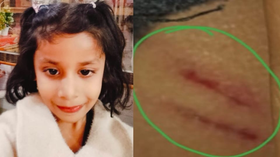 Stray Dogs Attack five-Year-Old Daughter of School Teacher in Meerut, Civic Body Faces Criticism