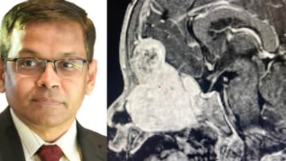 Chandigarh PGI Brain tumor removed from child through nose