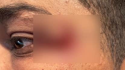 Kanpur student riding motorcycle was injured by Chinese kite string sustaining deep cuts near his nose and eye