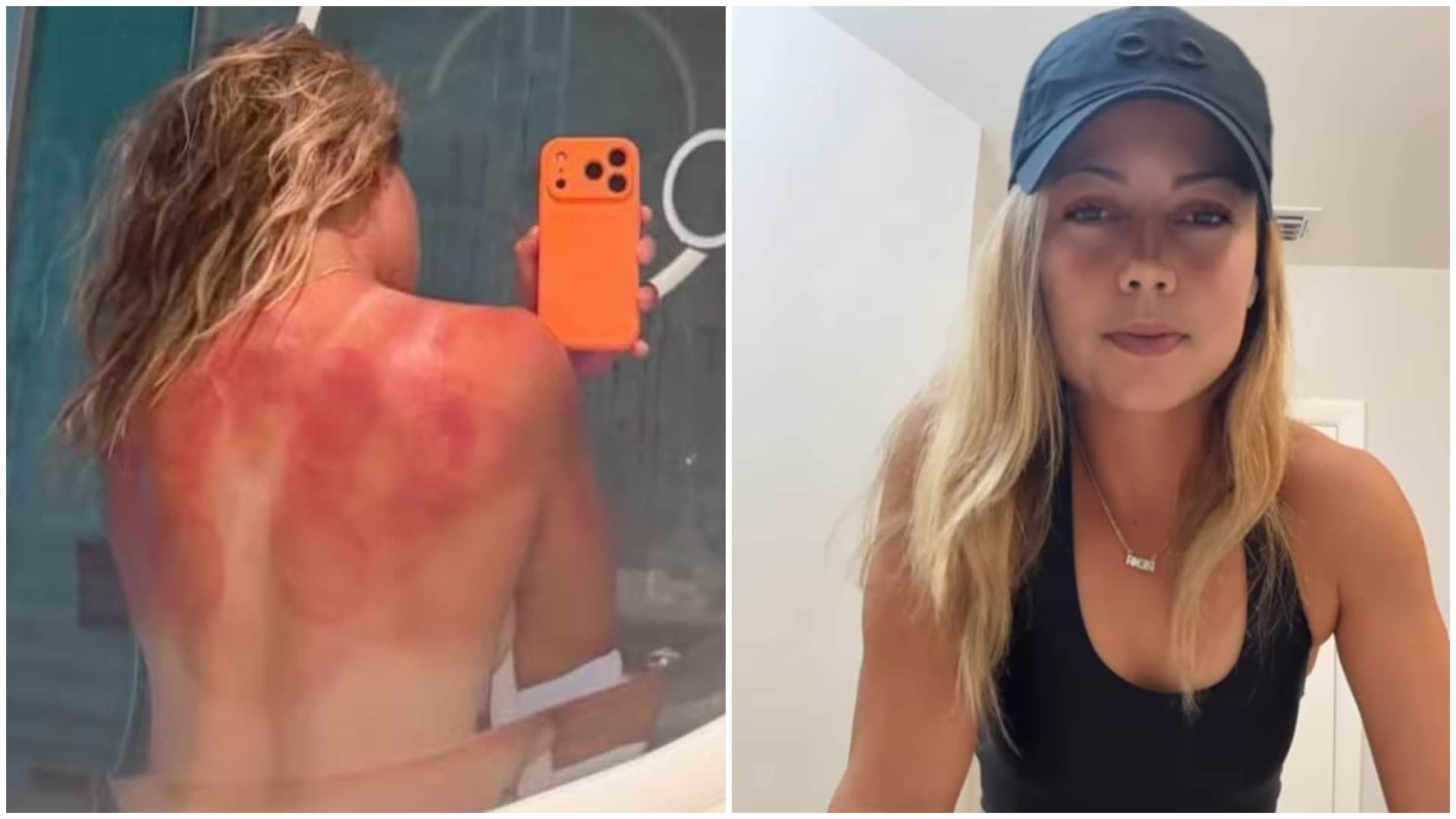 Sunburn Scare: Renata Zarazua Shares Topless Photo After Heat Trouble at Australian Open