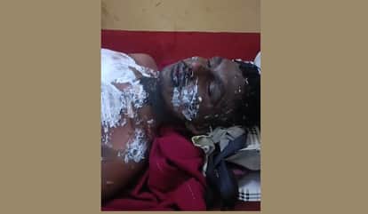 Auraiya Accident during chemistry practical at home student suffers burns in chemical explosion