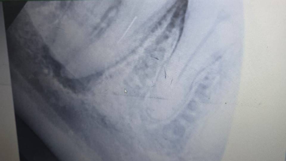 piece of syringe was also packed into tooth filling and this how truth was revealed