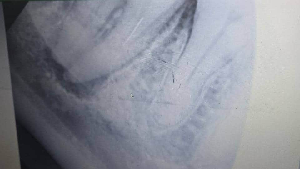 एक्सरे में दिखता सिरिंज का टुकड़ा।