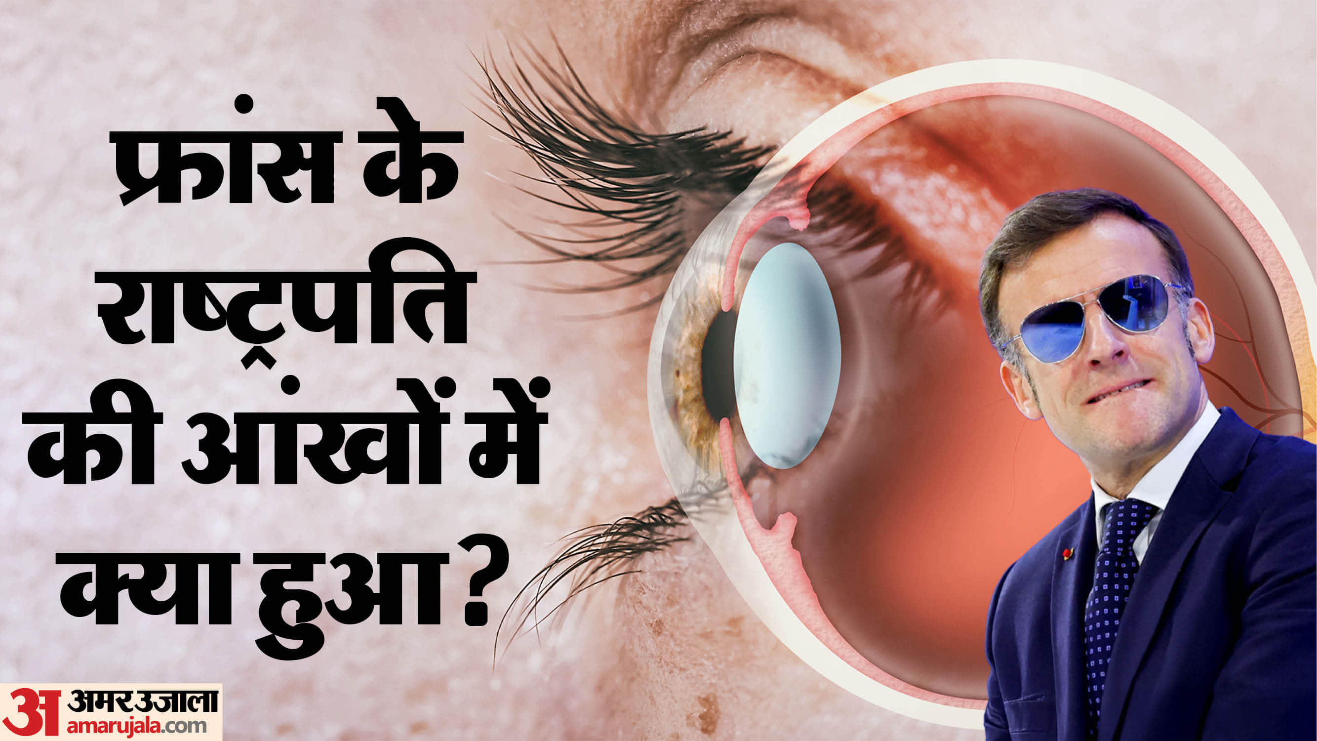 Emmanuel Macron appeared with puffy and extremely bloodshot eye know what is subconjunctival haemorrhage