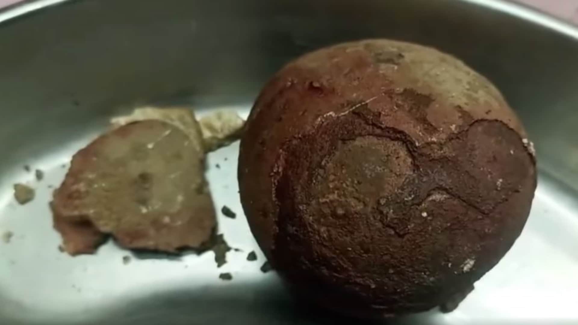 युवक के शरीर से निकाली आधा किलो की पथरी