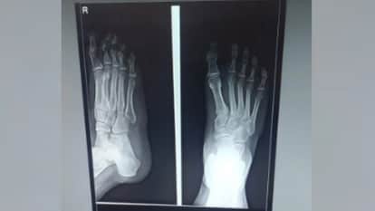 Lucknow:What if there's no radiologist... AI takes over, X-ray reports are being generated in 8 to 10 seconds