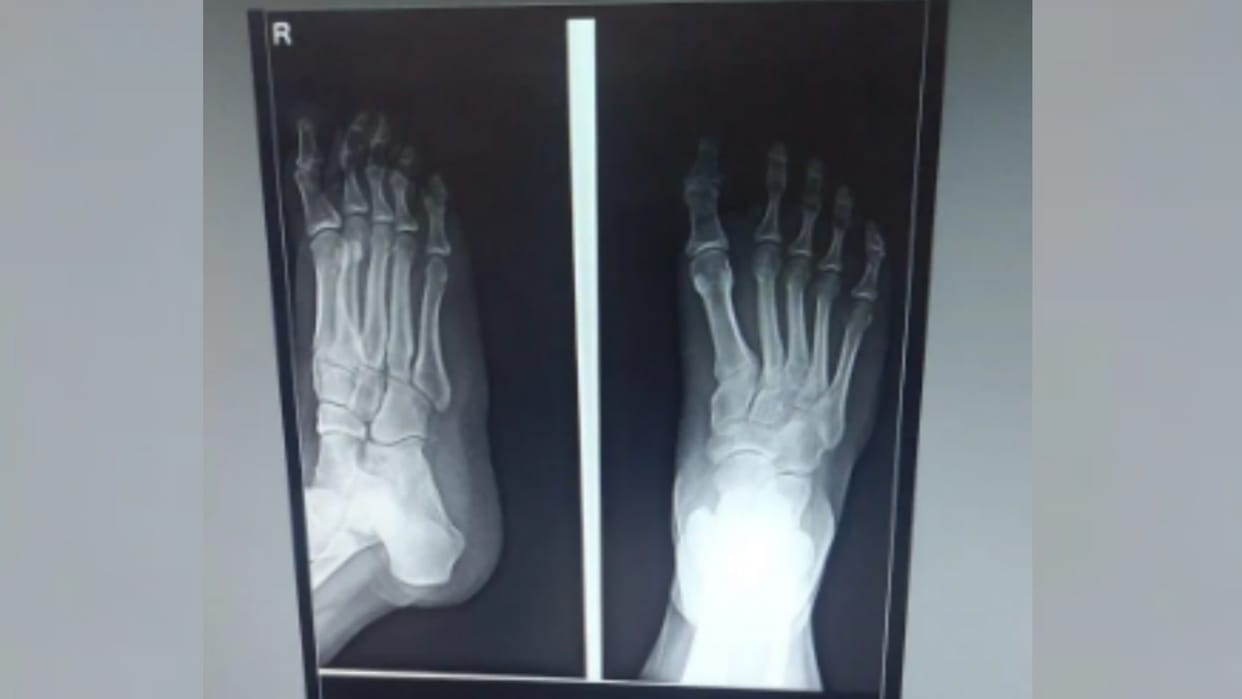 Lucknow:What if there's no radiologist... AI takes over, X-ray reports are being generated in 8 to 10 seconds