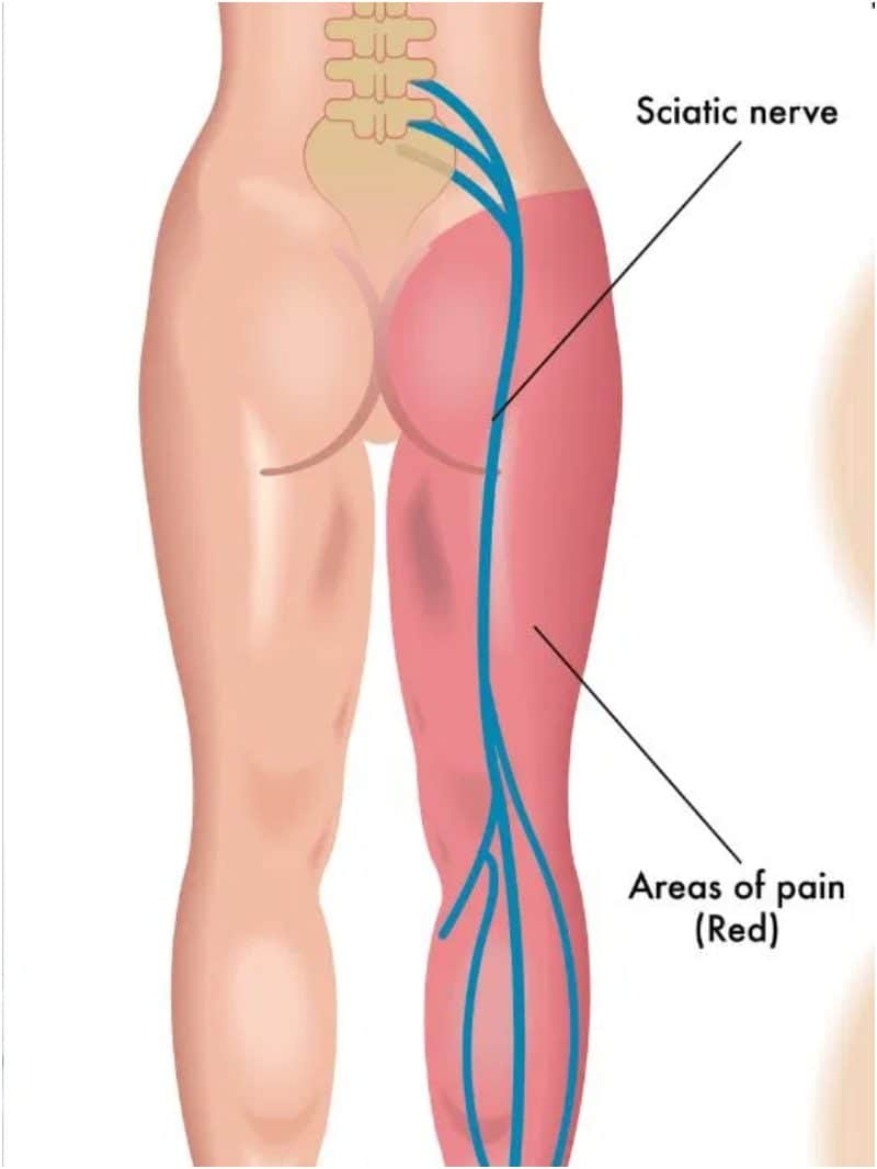 Sciatica Pain