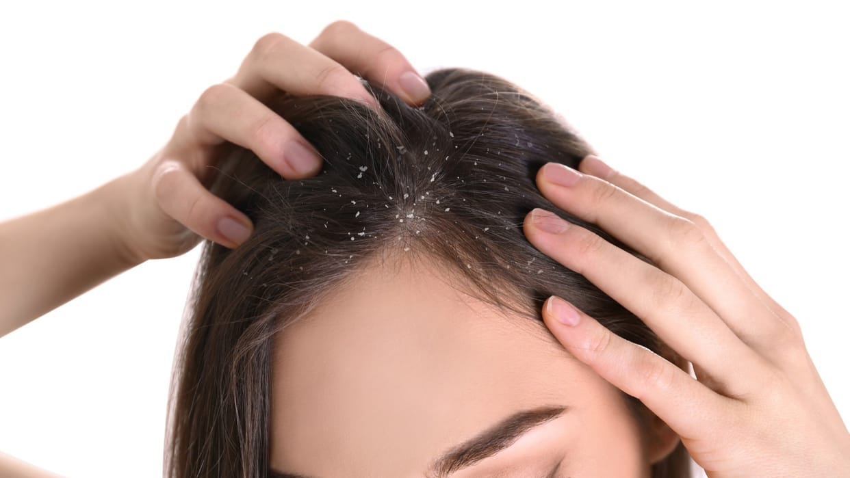 what causes dandruff in scalp how it grows know prevention tips in hindi